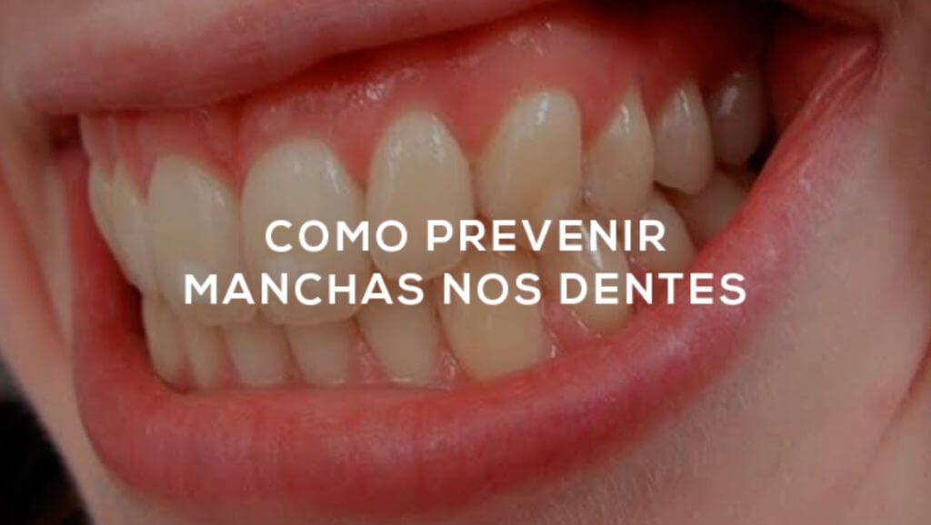 Como Prevenir Manchas nos Dentes